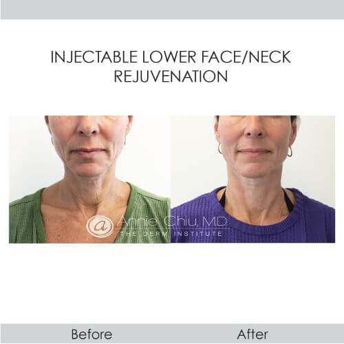 before and after face and neck rejuvenation with injectables front view female patient Redondo Beach, CA