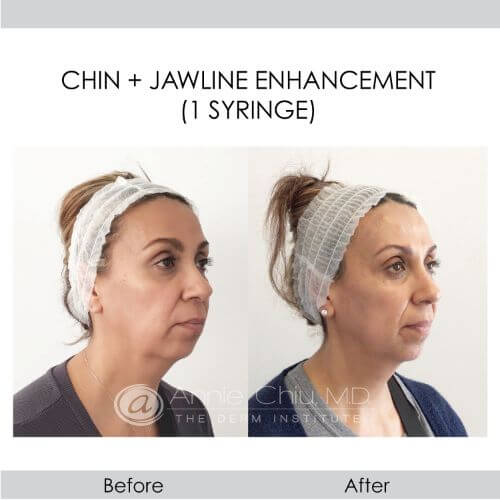 before and after chin and jawline with injectables right angled view female patient The Derm Institute Manhattan Beach, CA