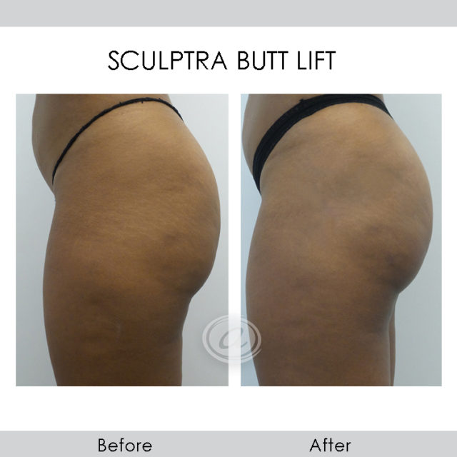 Non-Surgical Butt Lift - Cosmetic Dermatology Manhattan Beach