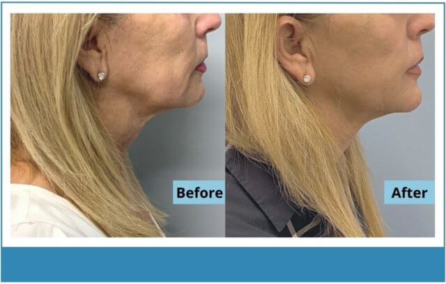 before and after skin tightening sofwave ultrasound right view female patient Redondo Beach