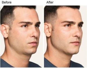 before and after non-surgical chin augmentation and rhinoplasty right view male patient Redondo Beach