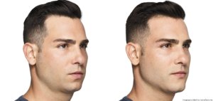 before and after non-surgical chin augmentation and rhinoplasty right view male patient The Derm Institute