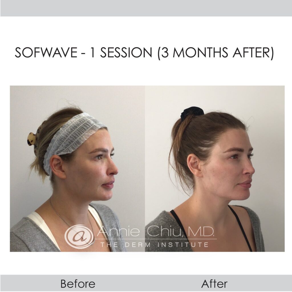 before and after Sofwave treatment Redondo Beach, CA